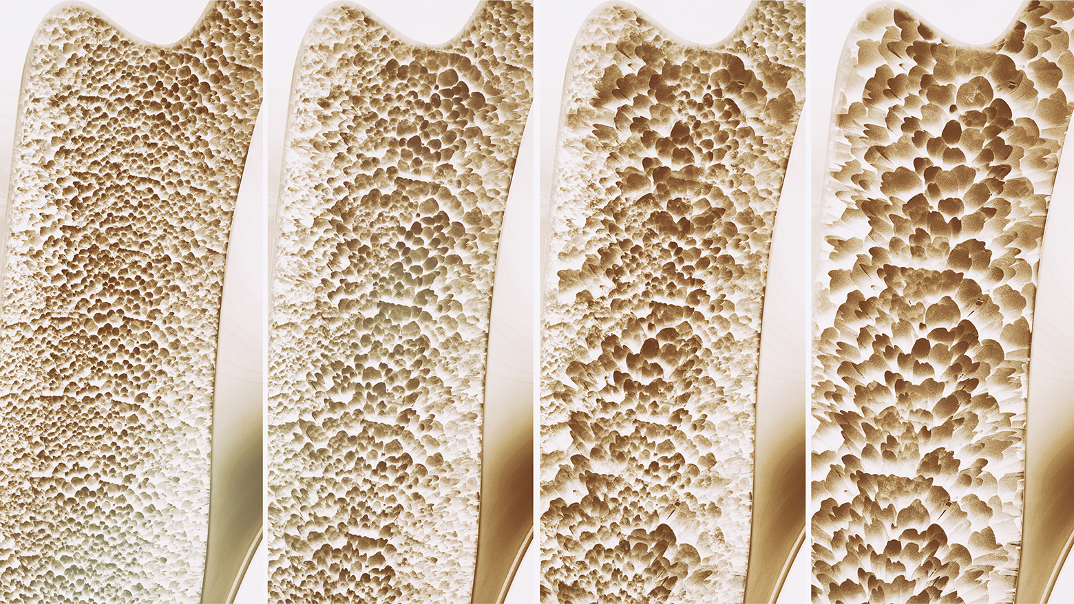 Utvikling av osteoporose