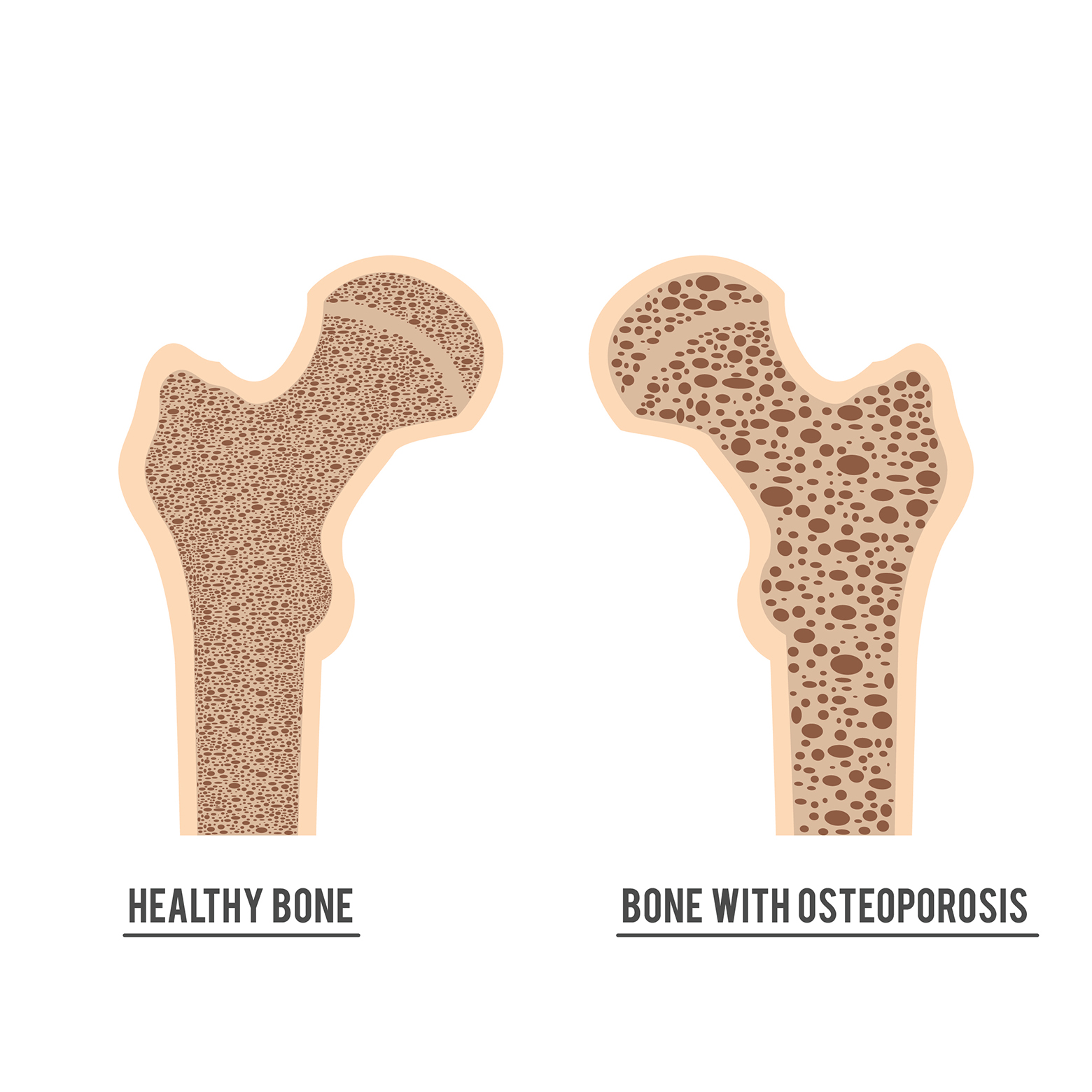 Friskt ben og ben med osteoporose